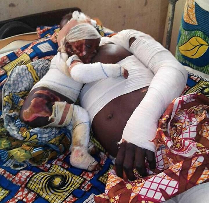 Powerful photo :Injured mum breastfeeds baby after surviving explosion