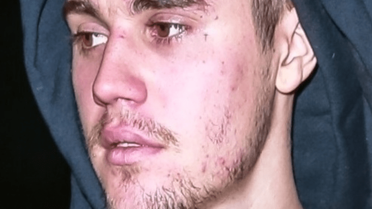 Justin Bieber’s Recent Photo Reveals His Acne-Filled Face